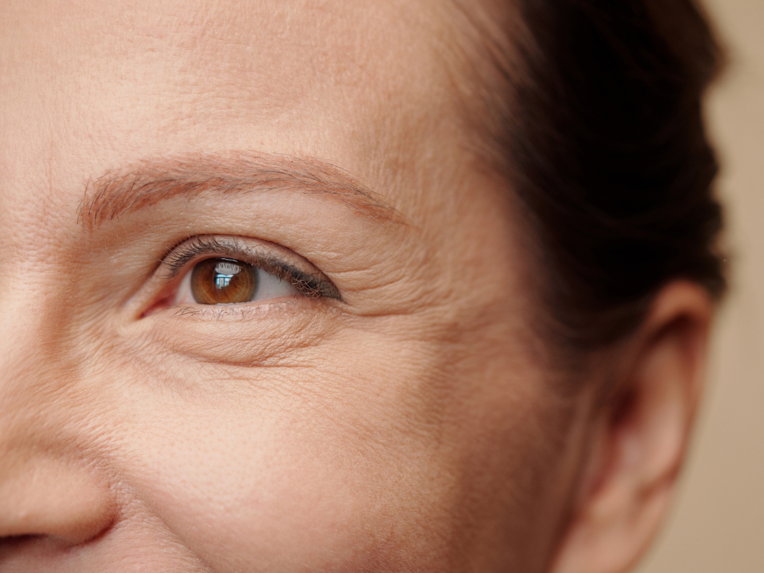 Common Causes of Sunken Eyes and Under Eye Hollows